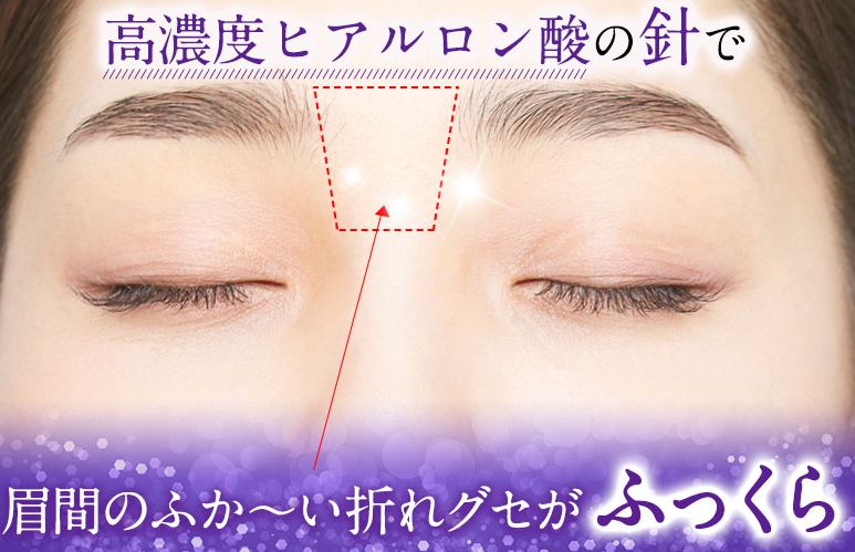ミケンディープパッチ解約